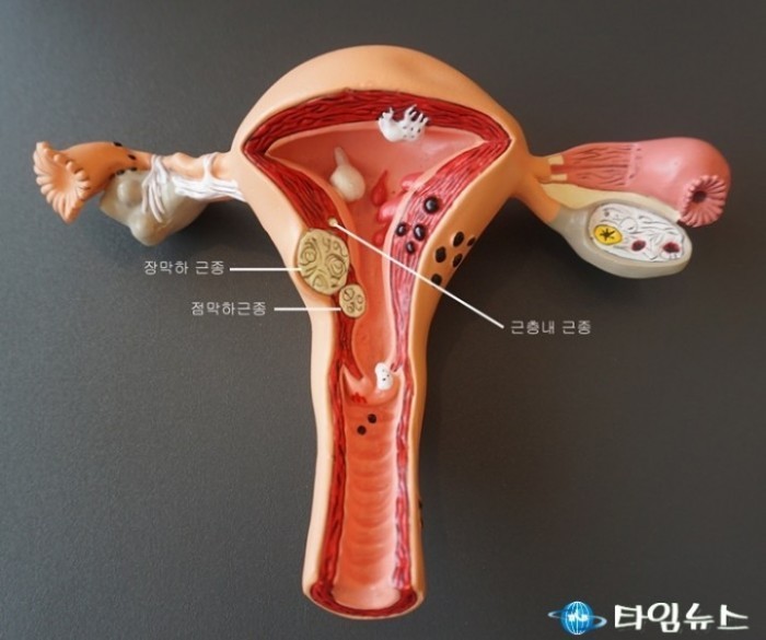 자궁근종 있는데 임신? 내 아이 안전할까